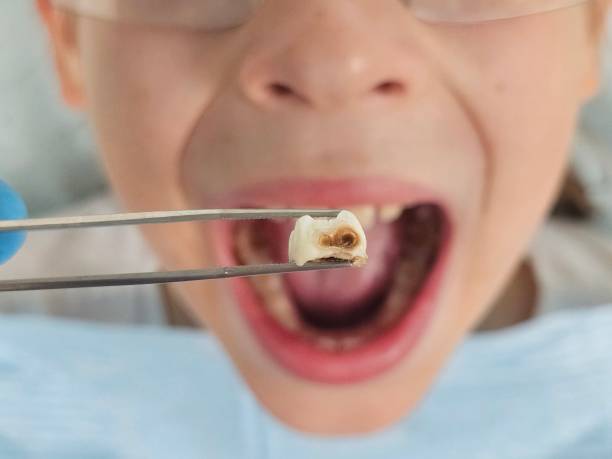 Best Emergency Tooth Extraction in Waverly, IA